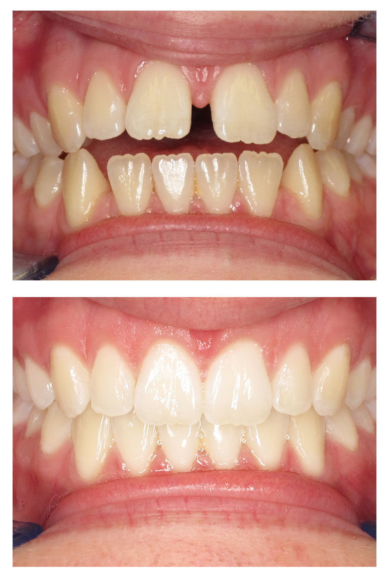 Teeth Whitening - Before & After - El Paso, TX