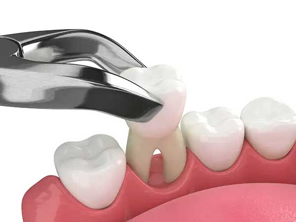 Same-Day Tooth Extraction: Walk-In Today!